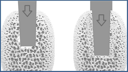 Bone Condensing: ein konisches Instrument wird vertikal so in den Knochen eingebracht, das sich die Kavernen im Knochen verdichten. Es entsteht Knochen mit kleineren Hohlräumen (rechts).